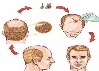 种植头发要多少钱_头发种植靠谱吗  第2张